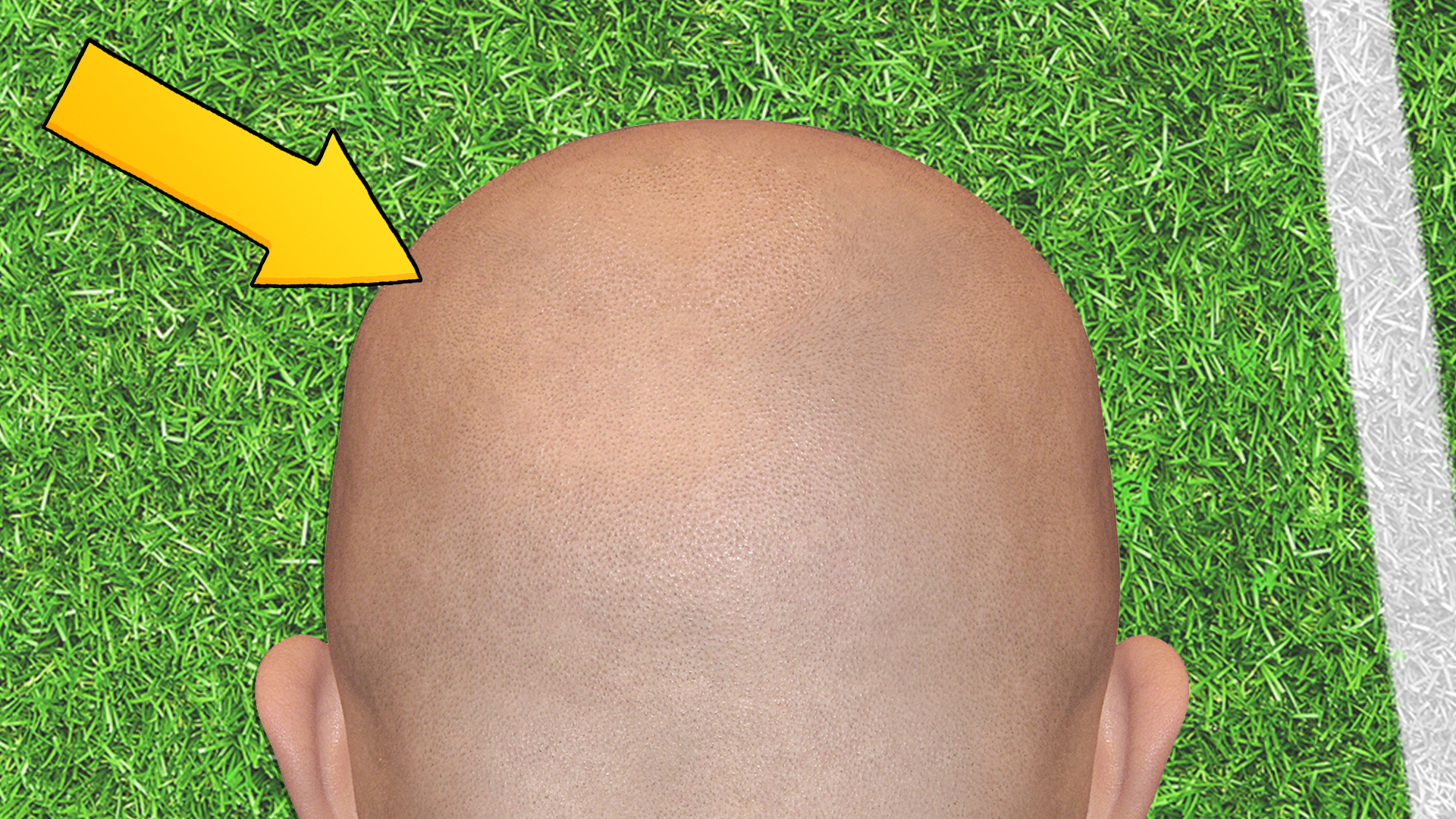 A bald head